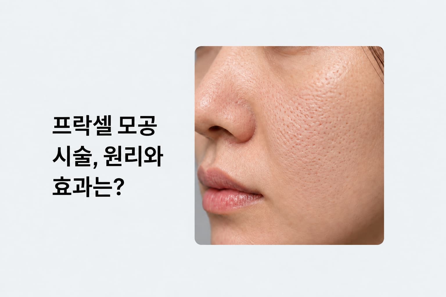 볼과 코 주변의 모공 피부 확대 사진가 프락셀 모공 시술 원리·효과 안내 썸네일