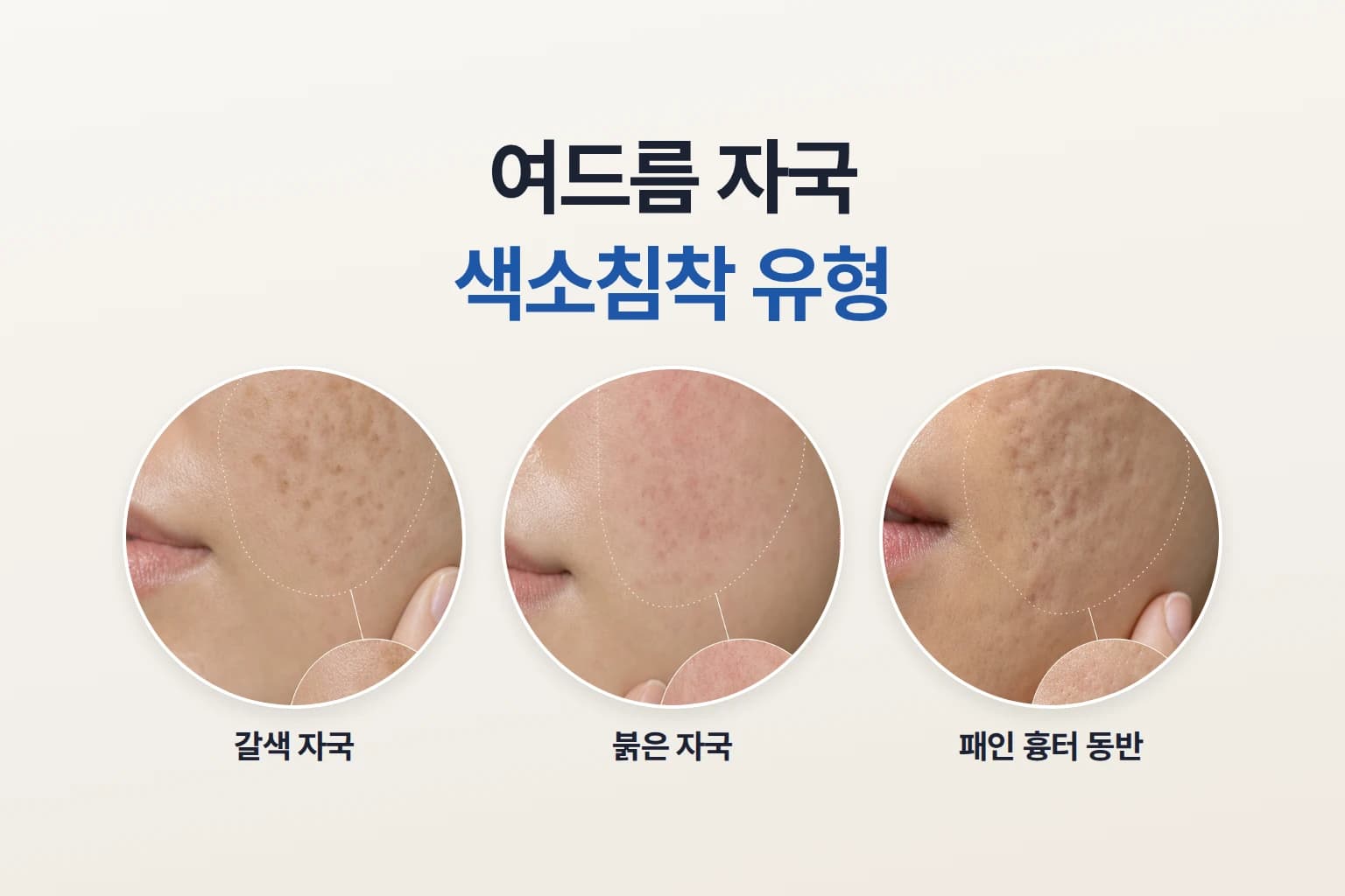 갈색 자국과 붉은 자국, 패인 흉터가 함께 있는 피부를 확대해 비교한 여드름 자국 색소침착 썸네일