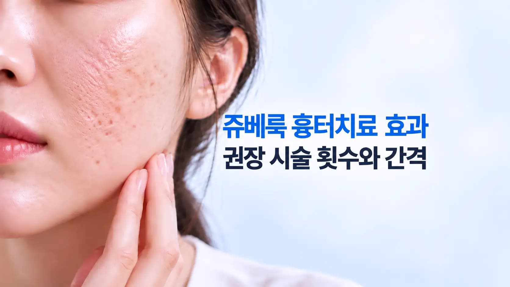 쥬베룩 흉터치료 효과와 권장 시술 횟수 및 간격을 안내하는 썸네일, 여성의 볼에 나타난 패인 여드름